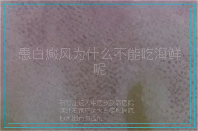 患白癜风为什么不能吃海鲜呢