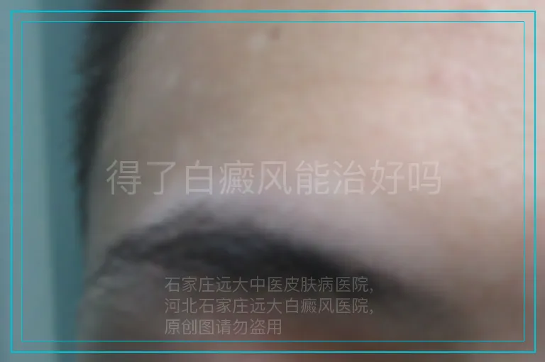 得了白癜风能治好吗