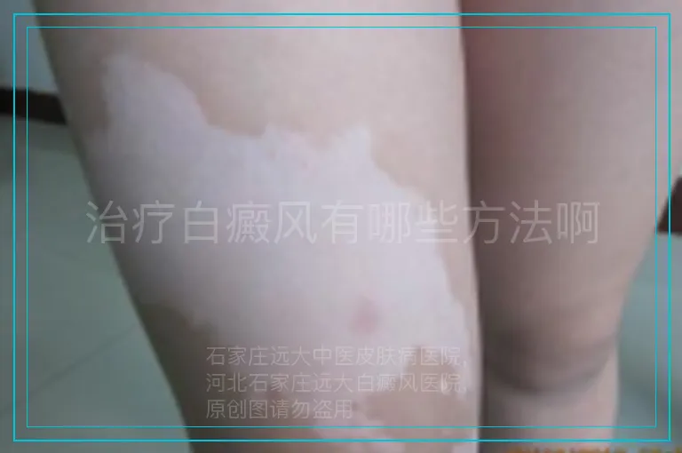 治疗白癜风有哪些方法啊