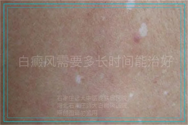 白癜风需要多长时间能治好