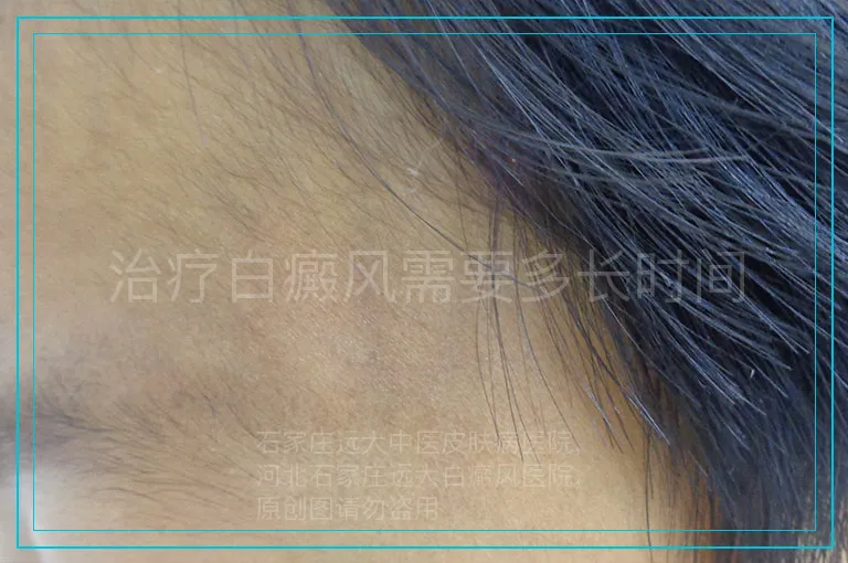 治疗白癜风需要多长时间
