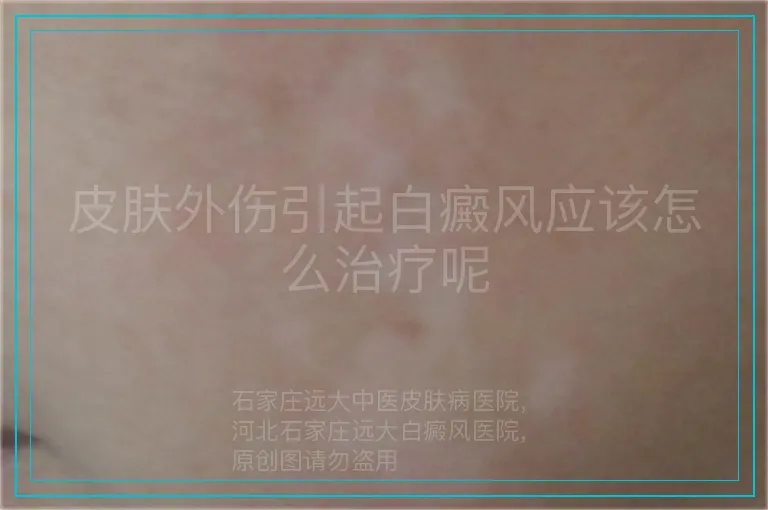 皮肤外伤引起白癜风应该怎么治疗呢