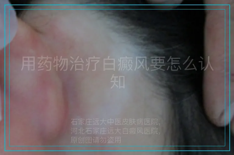 用药物治疗白癜风要怎么认知