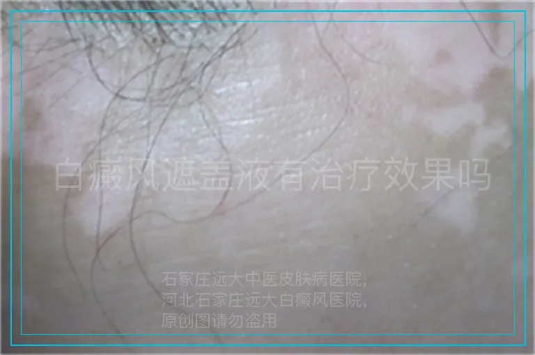 白癜风遮盖液有治疗效果吗