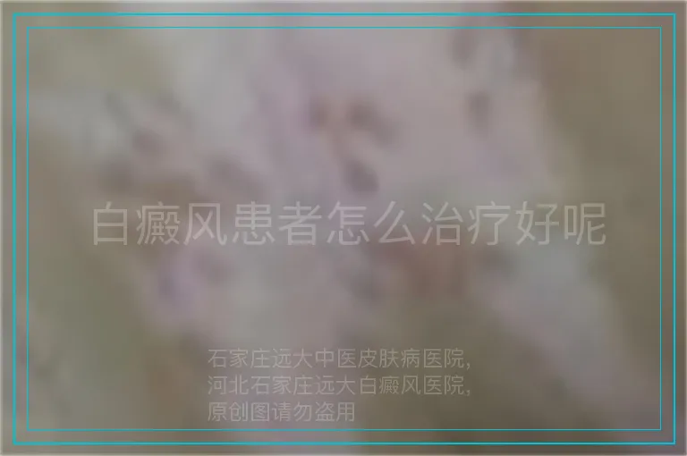 白癜风患者怎么治疗好呢