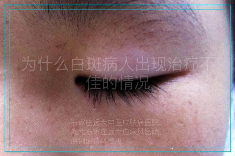 为什么白斑病人出现治疗不佳的情况