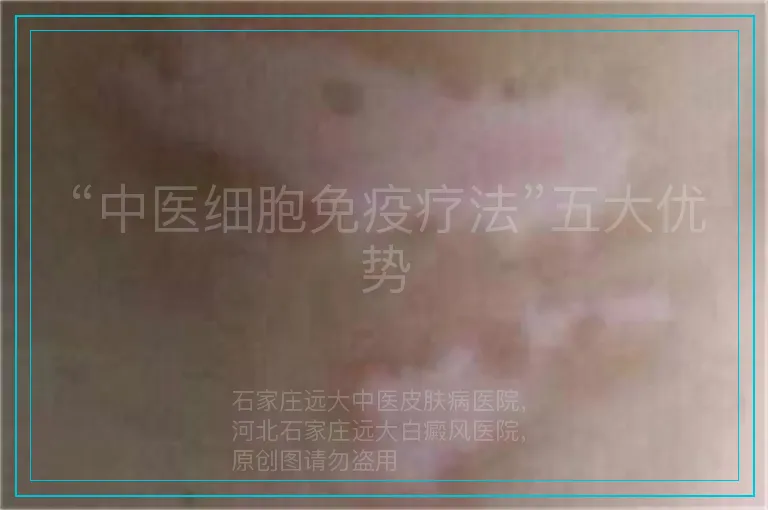 “中医细胞免疫疗法”五大优势