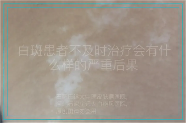 白斑患者不及时治疗会有什么样的严重后果