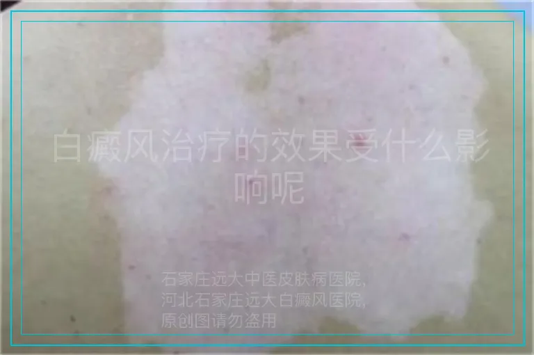 白癜风治疗的效果受什么影响呢