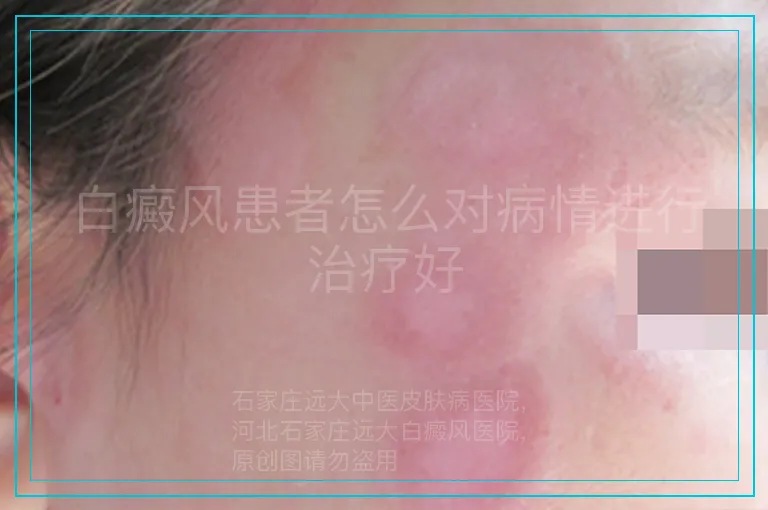 白癜风患者怎么对病情进行治疗好