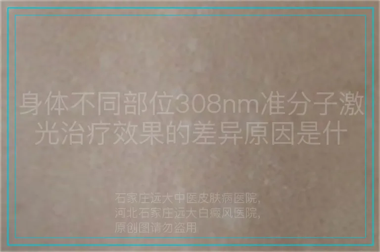 身体不同部位308nm准分子激光治疗效果的差异原因是什么?