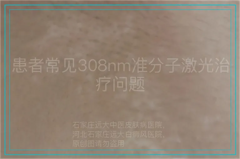 患者常见308nm准分子激光治疗问题
