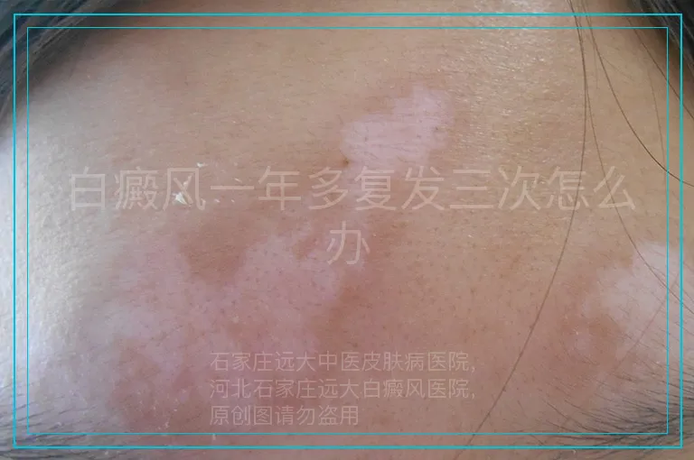 白癜风一年多复发三次怎么办