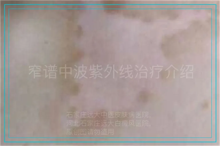 窄谱中波紫外线治疗介绍