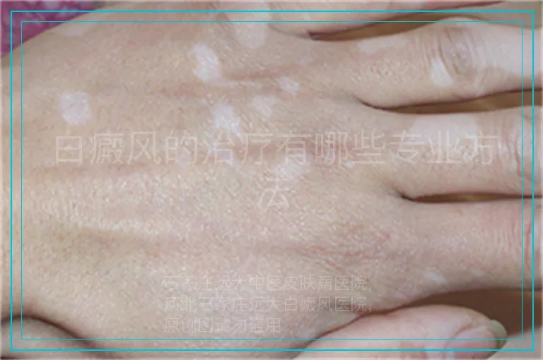 白癜风的治疗有哪些专业方法