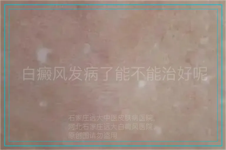 白癜风发病了能不能治好呢