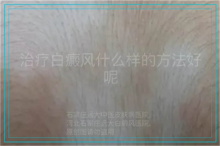 治疗白癜风什么样的方法好呢