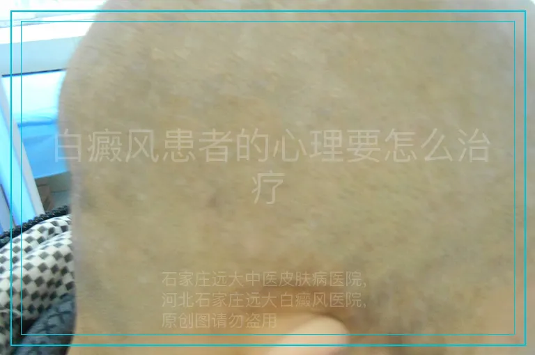 白癜风患者的心理要怎么治疗