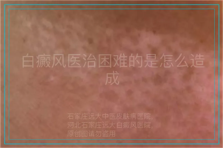白癜风医治困难的是怎么造成
