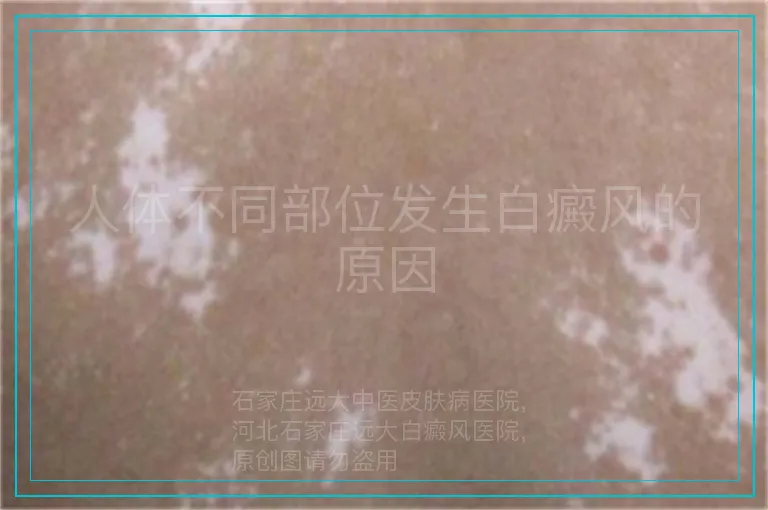 人体不同部位发生白癜风的原因