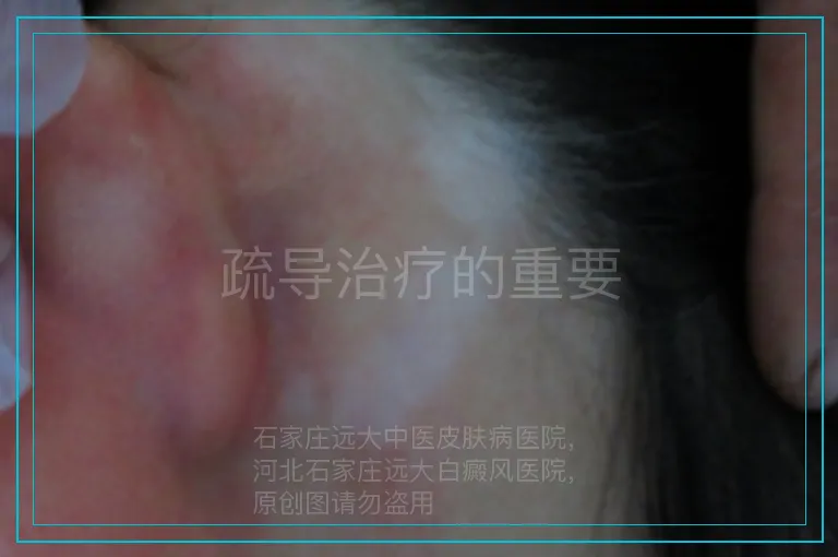 疏导治疗的重要