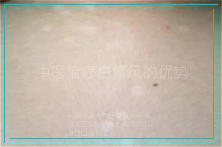 中医治疗白癜风的优势