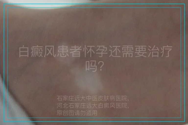 白癜风患者怀孕还需要治疗吗？