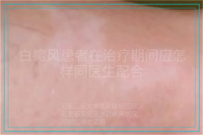 白癜风患者在治疗期间应怎样同医生配合