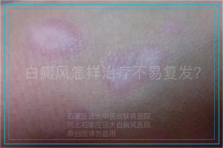 白癜风怎样治疗不易复发?