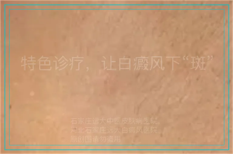 特色诊疗，让白癜风下“斑”