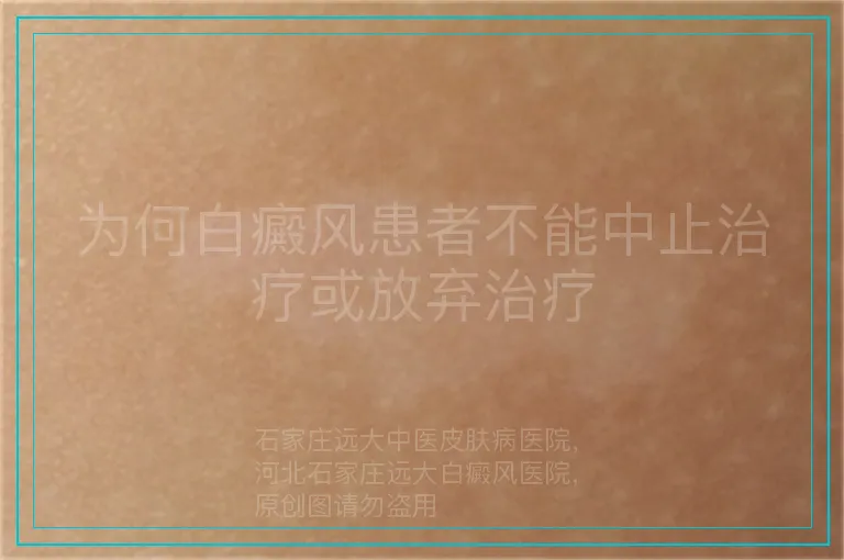 为何白癜风患者不能中止治疗或放弃治疗