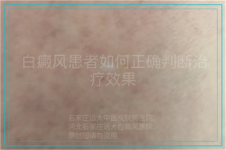 白癜风患者如何正确判断治疗效果