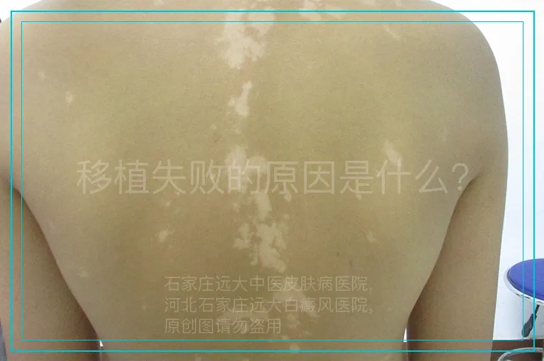移植失败的原因是什么？