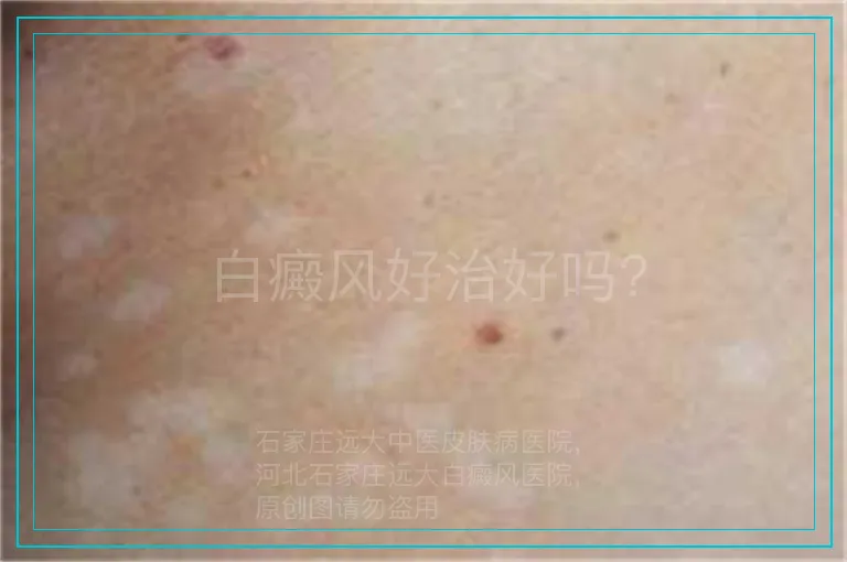 白癜风好治好吗?