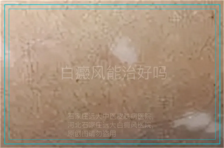 白癜风能治好吗