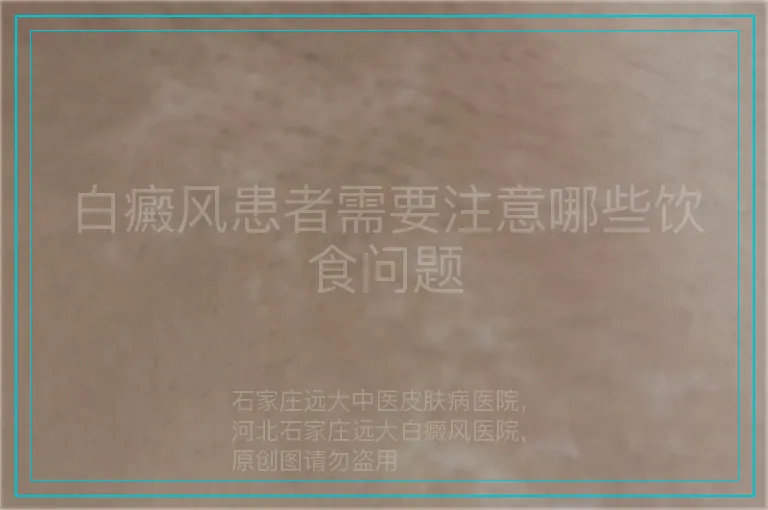 白癜风患者需要注意哪些饮食问题