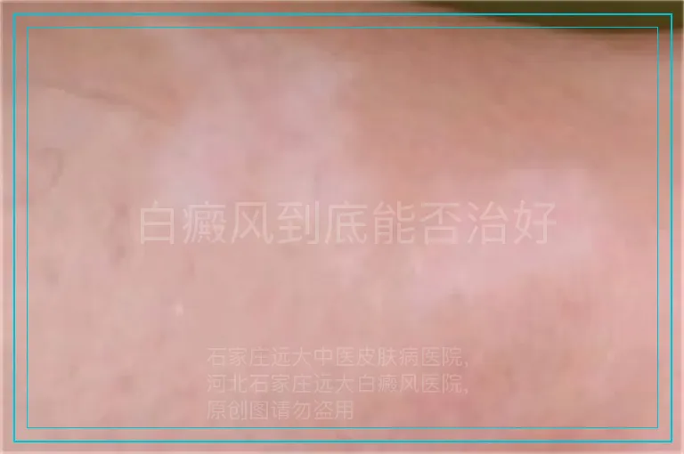 白癜风到底能否治好