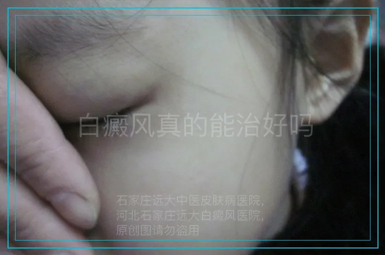 白癜风真的能治好吗