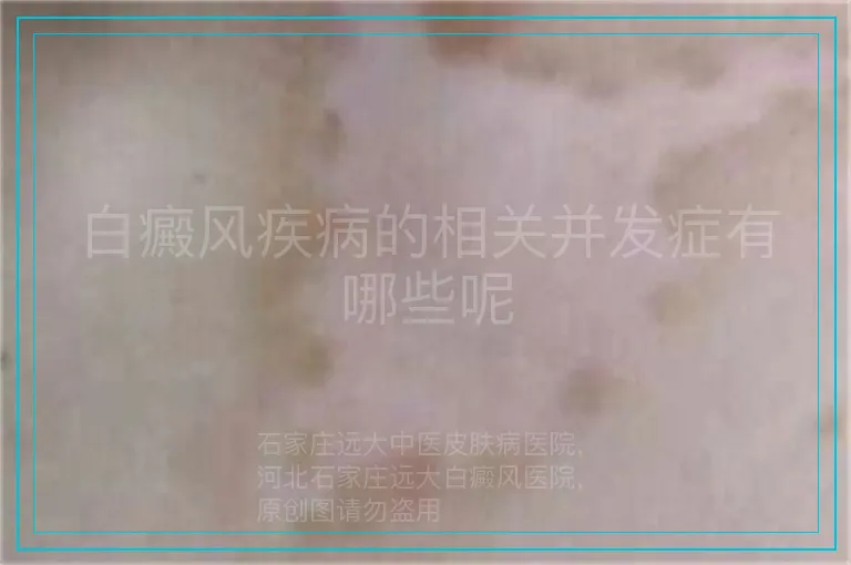 白癜风疾病的相关并发症有哪些呢