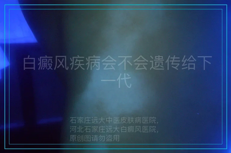 白癜风疾病会不会遗传给下一代