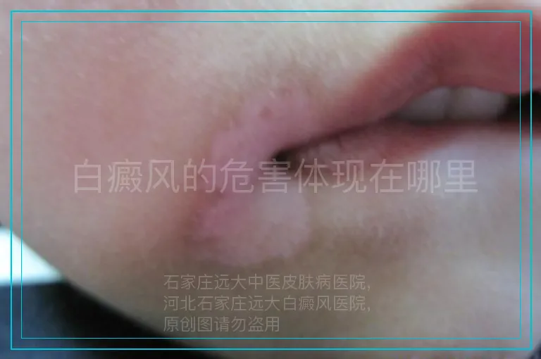 白癜风的危害体现在哪里