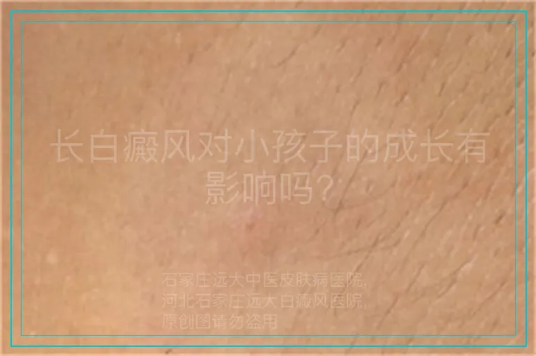 长白癜风对小孩子的成长有影响吗?