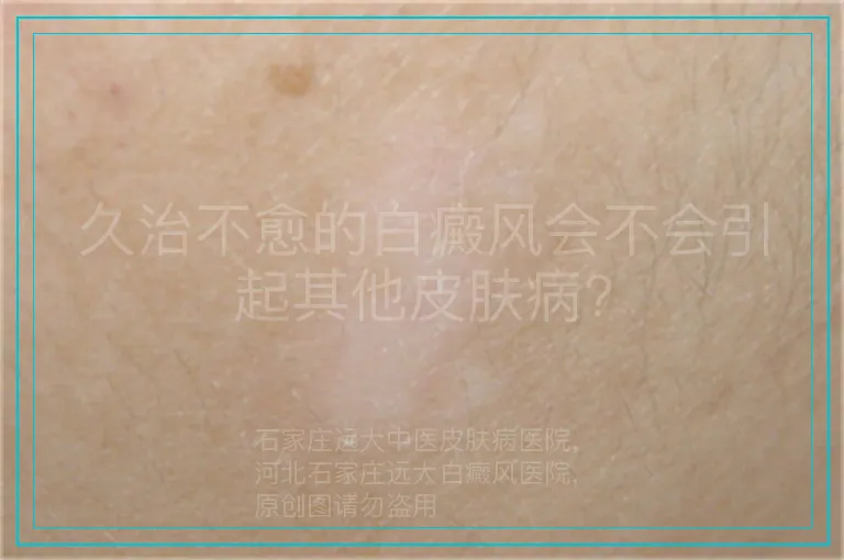 久治不愈的白癜风会不会引起其他皮肤病?