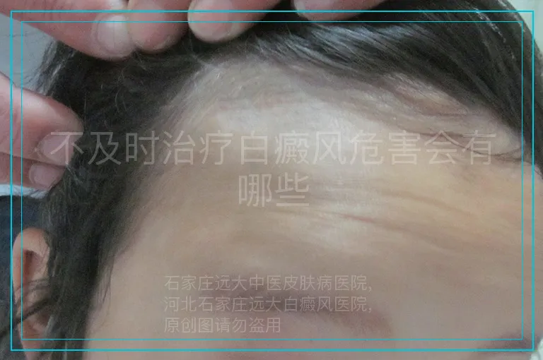不及时治疗白癜风危害会有哪些