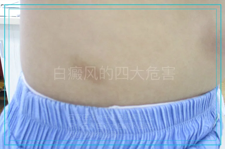 白癜风的四大危害