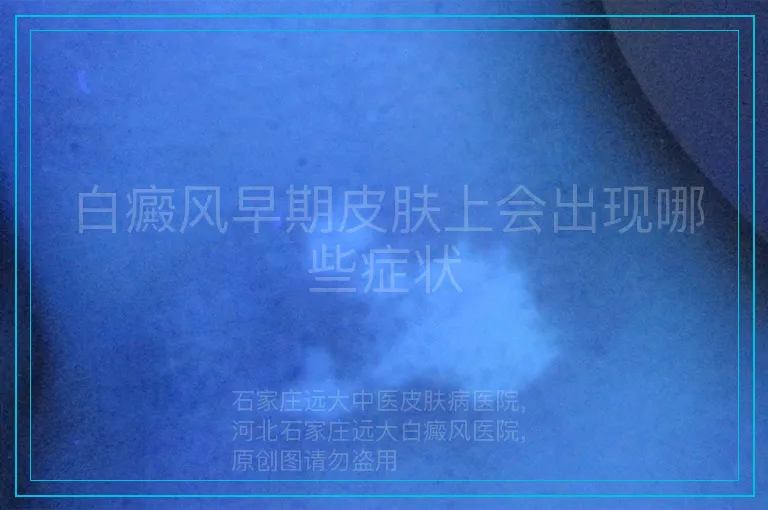 白癜风早期皮肤上会出现哪些症状