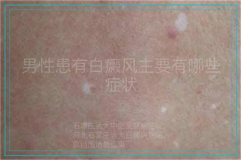 男性患有白癜风主要有哪些症状