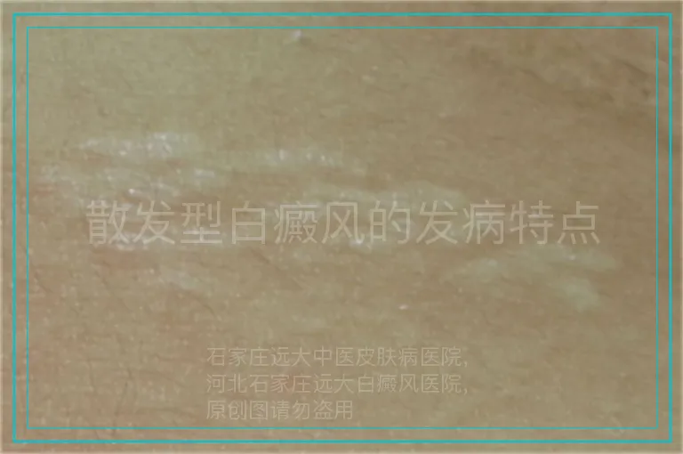散发型白癜风的发病特点