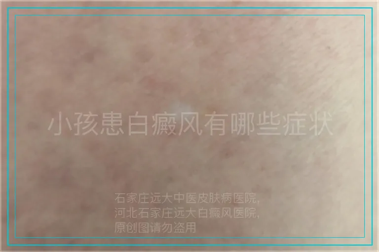 小孩患白癜风有哪些症状