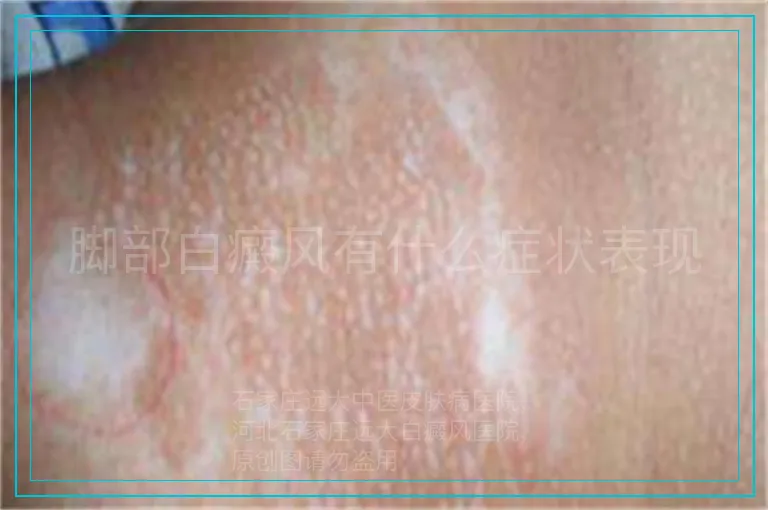 脚部白癜风有什么症状表现